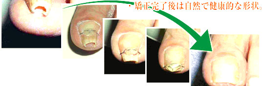 フェノール法による手術